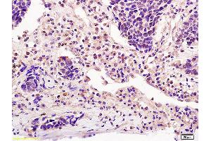 Formalin-fixed and paraffin embedded human lung carcinoma labeled with Anti-ICOS/CD278 Polyclonal Antibody, Unconjugated (ABIN742380) at 1:200 followed by conjugation to the secondary antibody and DAB staining (ICOS antibody  (AA 51-150))