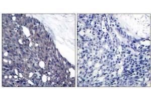 Immunohistochemical analysis of paraffin-embedded human breast carcinoma tissue using IκB-α (Ab-42) antibody (E021176). (NFKBIA antibody)