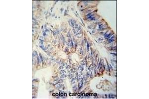 B3GNT6 Antibody (Center) (ABIN653842 and ABIN2843106) immunohistochemistry analysis in formalin fixed and paraffin embedded human colon carcinoma followed by peroxidase conjugation of the secondary antibody and DAB staining.