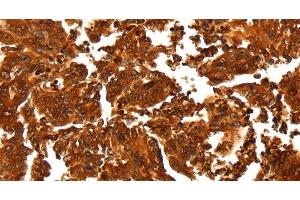 Immunohistochemistry of paraffin-embedded Human gastic cancer using ALDOA Polyclonal Antibody at dilution of 1:30 (ALDOA antibody)