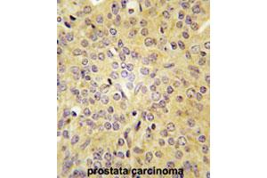 Formalin-fixed and paraffin-embedded human prostate carcinomareacted with LARS polyclonal antibody , which was peroxidase-conjugated to the secondary antibody, followed by AEC staining.