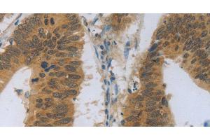 Immunohistochemistry of paraffin-embedded Human colon cancer using TNFRSF11B Polyclonal Antibody at dilution of 1:30 (Osteoprotegerin antibody)