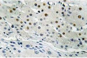 Immunohistochemistry (IHC) analyzes of Dlx-4 antibody in paraffin-embedded human liver carcinoma tissue. (DLX4 antibody)