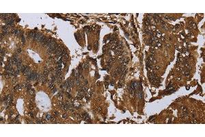 Immunohistochemistry of paraffin-embedded Human colon cancer tissue using MYBBP1A Polyclonal Antibody at dilution 1:40 (MYBBP1A antibody)