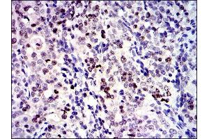 Immunohistochemistry (IHC) image for anti-Baculoviral IAP Repeat-Containing 5 (BIRC5) antibody (ABIN1845166) (Survivin antibody)