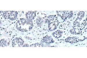 Immunohistochemistry of paraffin-embedded Human esophagus cancer tissue using RARG Polyclonal Antibody at dilution of 1:55(x200) (Retinoic Acid Receptor gamma antibody)