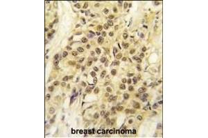 Formalin-fixed and paraffin-embedded human breast carcinoma tissue reacted with HMOF/MYST1 antibody (C-term) (ABIN387971 and ABIN2844732) , which was peroxidase-conjugated to the secondary antibody, followed by DAB staining. (MYST1 antibody  (C-Term))