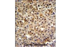 KI Antibody (C-term) (ABIN651358 and ABIN2840200) IHC analysis in formalin fixed and paraffin embedded human cervix carcinoma followed by peroxidase conjugation of the secondary antibody and DAB staining.