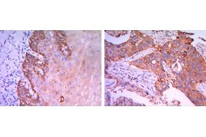 Immunohistochemical analysis of paraffin-embedded esophagus tissues (left) and human lung cancer (right) using Rab25 mouse mAb with DAB staining.