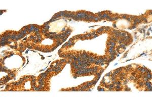 Immunohistochemistry of paraffin-embedded Human thyroid cancer tissue using SMYD4 Polyclonal Antibody at dilution 1:40 (SMYD4 antibody)