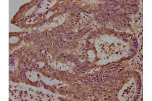 IHC image of ABIN7165733 diluted at 1:100 and staining in paraffin-embedded human colon cancer performed on a Leica BondTM system. (DENND11/KIAA1147 antibody  (AA 2-233))