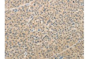 The image on the left is immunohistochemistry of paraffin-embedded Human liver cancer tissue using ABIN7189710(AFF2 Antibody) at dilution 1/25, on the right is treated with synthetic peptide. (AFF2 antibody)