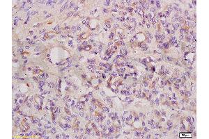 Formalin-fixed and paraffin embedded mouse tumor tissue labeled with Anti ANGPT3 ANG3 ANGPT4 ANG4 Polyclonal Antibody, unconjugated (ABIN737466) at 1:200 followed by incubation with conjugated secondary antibody and DAB staining. (Angiopoietin 4 antibody  (AA 410-503))