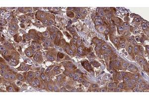 ABIN6277630 at 1/100 staining Human liver cancer tissue by IHC-P. (GNAS antibody  (C-Term))