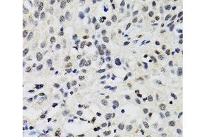 Immunohistochemistry of paraffin-embedded Human lung cancer using SMARCAD1 Polyclonal Antibody at dilution of 1:100 (40x lens). (SMARCAD1 antibody)