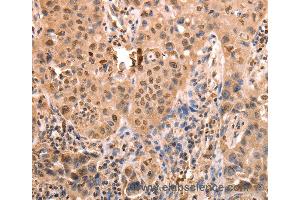 Immunohistochemistry of Human lung cancer using ACO2 Polyclonal Antibody at dilution of 1:30 (ACO2 antibody)