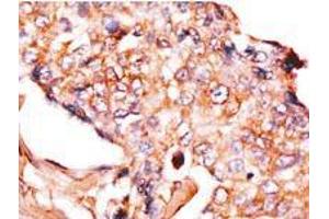 Formalin-fixed and paraffin-embedded human breast carcinoma reacted with anti-NP1 (Nptx1) Antibody (Center), which was peroxidase-conjugated to the secondary antibody, followed by DAB staining. (NPX1 antibody  (Middle Region))