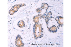 Immunohistochemistry of Human thyroid cancer using ADCY5 Polyclonal Antibody at dilution of 1:30 (ADCY5 antibody)