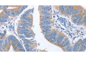 Immunohistochemistry of paraffin-embedded Human colon cancer using NCAPD2 Polyclonal Antibody at dilution of 1:40 (NCAPD2 antibody)