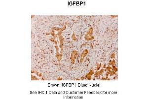 Sample Type :  Human lung adenocarcinoma  Primary Antibody Dilution :  1:300  Secondary Antibody :  Anti-rabbit-linker, Fbex-HRP  Secondary Antibody Dilution :  NOT FOUND  Color/Signal Descriptions :  Brown: IGFBP1 Blue: Nuclei  Gene Name :  IGF2BP1  Submitted by :  Haodong Xu.