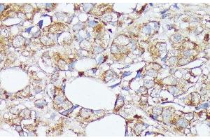 Immunohistochemistry of paraffin-embedded Human mammary cancer using SLC7A2 Polyclonal Antibody at dilution of 1:100 (40x lens).