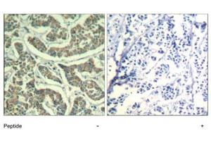 Immunohistochemical analysis of paraffin-embedded human breast carcinoma tissue using ATR polyclonal antibody . (ATR antibody  (Ser428))