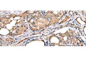 Immunohistochemistry of paraffin-embedded Human thyroid cancer tissue using LRRC19 Polyclonal Antibody at dilution of 1:30(x200) (LRRC19 antibody)