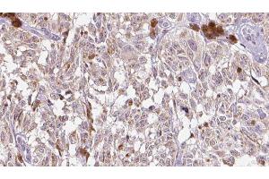 ABIN6275310 at 1/100 staining Human Melanoma tissue by IHC-P. (VGF antibody  (Internal Region))