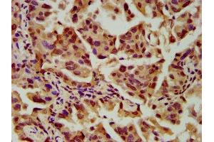 IHC image of ABIN7169791 diluted at 1:600 and staining in paraffin-embedded human lung cancer performed on a Leica BondTM system. (SLC2A4RG antibody  (AA 1-100))