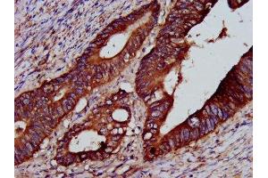 IHC image of ABIN7166237 diluted at 1:200 and staining in paraffin-embedded human colon cancer performed on a Leica BondTM system. (PTP4A2 antibody  (AA 1-164))
