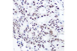 Immunohistochemistry of paraffin-embedded human colon carcinoma using S Rabbit pAb (ABIN6128698, ABIN6147392, ABIN6147393 and ABIN6215703) at dilution of 1:100 (40x lens). (SART3 antibody  (AA 664-963))