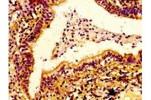 IHC image of ABIN7151695 diluted at 1:100 and staining in paraffin-embedded human lung cancer performed on a Leica BondTM system.