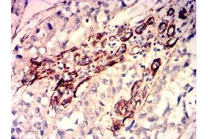 Immunohistochemical analysis of paraffin-embedded bladder cancer tissues using CALD1 mouse mAb with DAB staining. (Caldesmon antibody  (AA 26-207))
