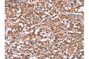 The image on the left is immunohistochemistry of paraffin-embedded Human thyroid cancer tissue using ABIN7190999(HRASLS2 Antibody) at dilution 1/20, on the right is treated with synthetic peptide. (HRASLS2 antibody)