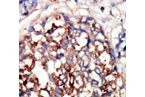 IHC analysis of FFPE human hepatocarcinoma tissue stained with the DYRKB antibody (DYRK1B antibody  (AA 561-589))