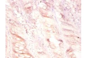 Immunohistochemistry of paraffin-embedded human colon cancer using ABIN7175129 at dilution of 1:100 (PLAU antibody  (AA 21-173))