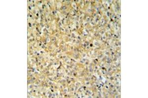 Immunohistochemistry analysis in formalin fixed and paraffin embedded kidney carcinoma reacted with MAPK1IP1L Antibody (Center) followed which was peroxidase conjugated to the secondary antibody and followed by DAB staining.
