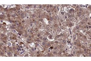 ABIN6273965 at 1/100 staining Human liver cancer tissue by IHC-P. (OR10Q1 antibody  (C-Term))
