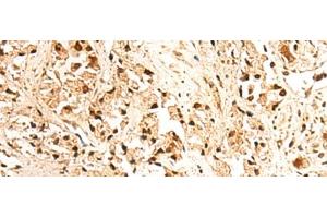 Immunohistochemistry of paraffin-embedded Human prost ate cancer tissue using JPT2 Polyclonal Antibody at dilution of 1:65(x200) (JPT2 antibody)