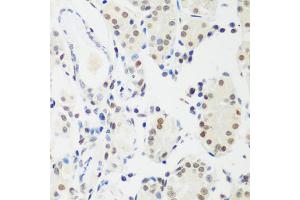 Immunohistochemistry of paraffin-embedded human gastric cancer using MECP2 antibody. (MECP2 antibody)