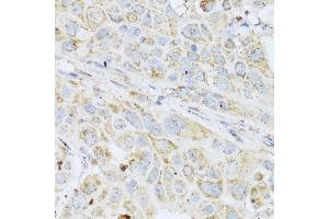 Immunohistochemistry of paraffin-embedded human esophageal cancer using LYZ antibody (ABIN5975352) at dilution of 1/100 (40x lens). (LYZ antibody)