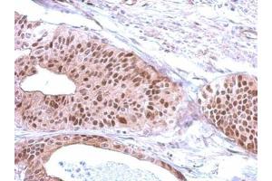 IHC-P Image Immunohistochemical analysis of paraffin-embedded human gastric cancer, using RFC3, antibody at 1:500 dilution. (RFC3 antibody)