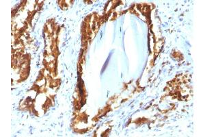 Formalin-fixed, paraffin-embedded human Prostate Carcinoma stained with PSAP Mouse Recombinant Monoclonal Antibody (rACPP/1338). (Recombinant ACPP antibody)