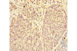 Immunohistochemistry of paraffin-embedded human ovarian cancer using ABIN7168416 at dilution of 1:100