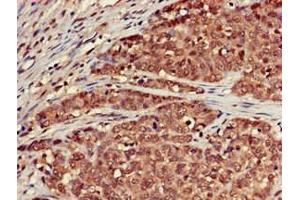 Immunohistochemistry of paraffin-embedded human ovarian cancer using ABIN7168699 at dilution of 1:100 (SCTR antibody  (AA 51-135))