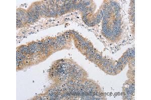Immunohistochemistry of Human colon cancer using ARHGEF9 Polyclonal Antibody at dilution of 1:50