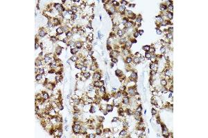 Immunohistochemistry of paraffin-embedded human liver cancer using CDC Rabbit mAb (ABIN7266261) at dilution of 1:100 (40x lens). (CDCA3 antibody)