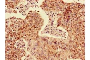 Immunohistochemistry of paraffin-embedded human cervical cancer using ABIN7143262 at dilution of 1:100 (Acyp2 antibody  (AA 28-87))