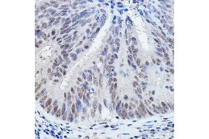 Immunohistochemistry of paraffin-embedded human colon carcinoma using DGCR8 Rabbit pAb (ABIN7266761) at dilution of 1:200 (40x lens). (DGCR8 antibody)