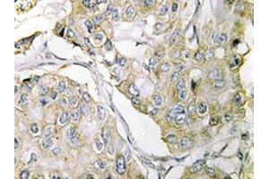Immunohistochemistry analyzes of TMPRSS3 antibody in paraffin-embedded human breast carcinoma tissue. (TMPRSS3 antibody)
